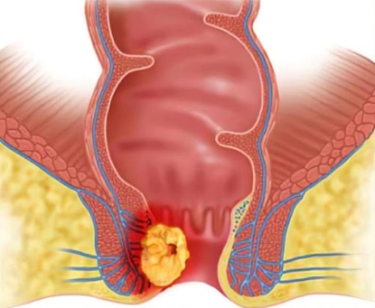Phòng ngừa ung thư ống hậu môn những điều cần biết
